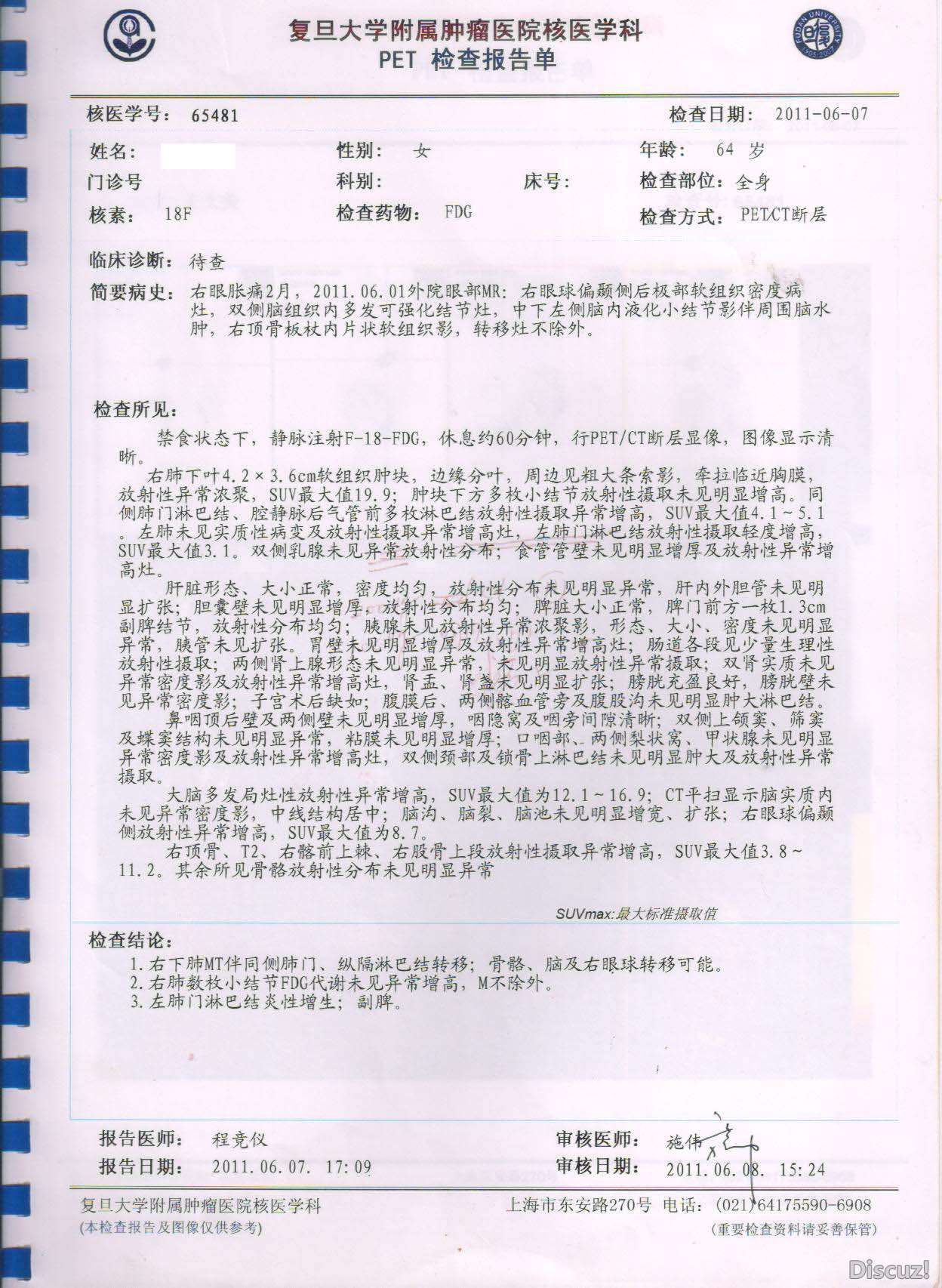 刚发现时PET CT 结果.jpg