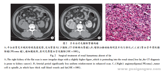 肾错构瘤的诊断与治疗2.png